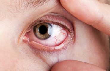 Kuru göz hastalığı nedir?